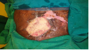 Clipping in External Tissue Expansion and Wound Closure