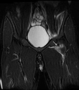 STIR coronal hips MRI at level of pubic symphysis at level of the 4 mm behind from Figure 3.