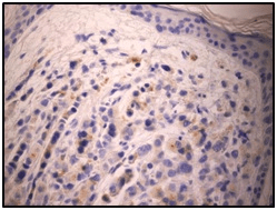 Prostate Specific Immunohistochemical Staining of the Same Skin Sample at 400x (visualization: cytoplasmic)
