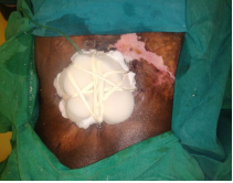 External Tissue Expansion with Wound Closure