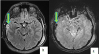 MRI Brain Imaging in Assessment