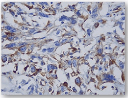 Collecting (Bellini) Duct Carcinoma
