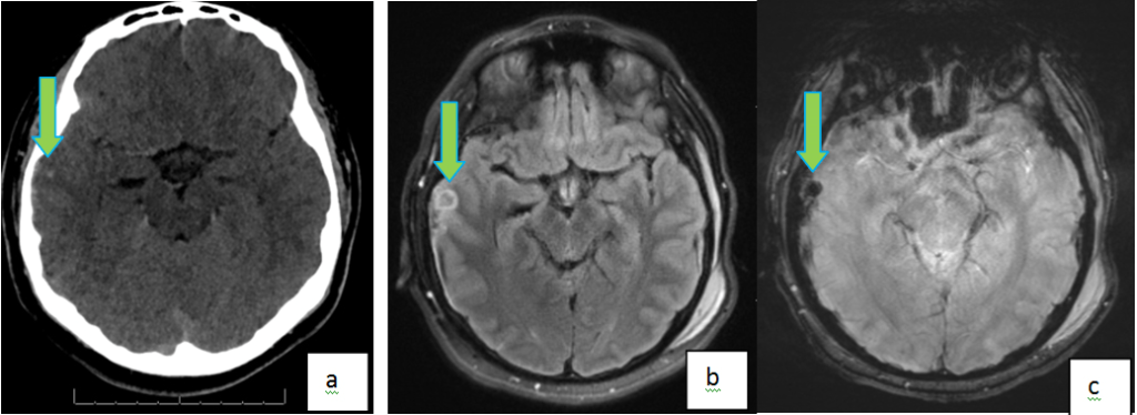 Right Temporal Hemorrhagic Contusions in a 16 Year Old