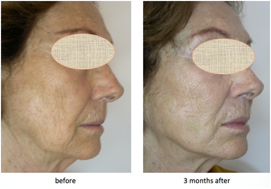 The Side of the Face Treated with PLLA/PCL Threads