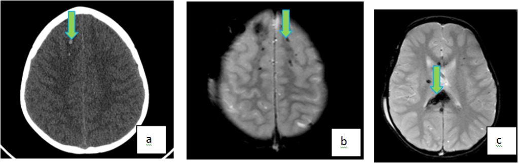 Diffuse Axonal Injury in a 14 Year Old Following High Speed Motor