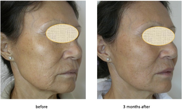 The Side of the Face Treated with PLLA/PCL Threads