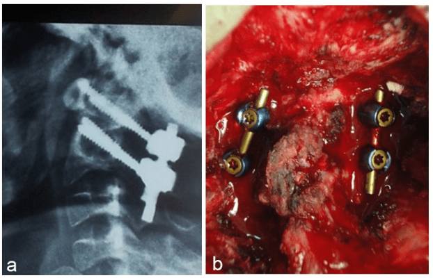 Management of OO with Harms technique; (a) lateral radiograph. (b) intraoperative photograph.