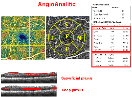 Does OCT Angiography of Macula