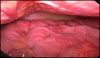 Chylous Ascites Associated with Internal Hernia Post-Roux-en-Y Gastric Bypass: A Case Report