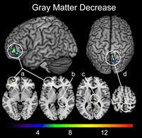 Brain Gray Matter Changes
