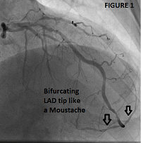 “The Moustache Sign”: A Common Morphological Characteristic in Cardiovascular Disease Treatment