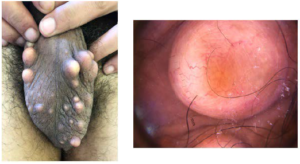 Multiple and Bilateral Calcifiedcutaneous Lesions