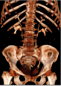 3D Reconstruction of CT Scan