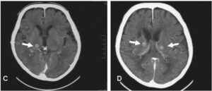 Head CT with Contrast-media Depicted that Bilateral Thalamic Metastatic Lesions are getting Larger in Size. 
