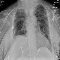 Chest X-ray Showed a Hazy Left Upper Lung Infiltrate