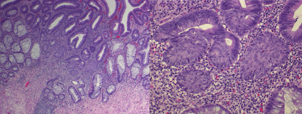 Multiple foci of benign squamous metaplasia in a tubular adenoma 