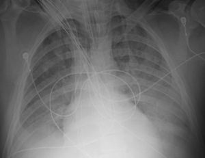 Hospital Day 1, Anterior-Posterior Chest x-ray Demonstrating Widespread Pulmonary Edema
