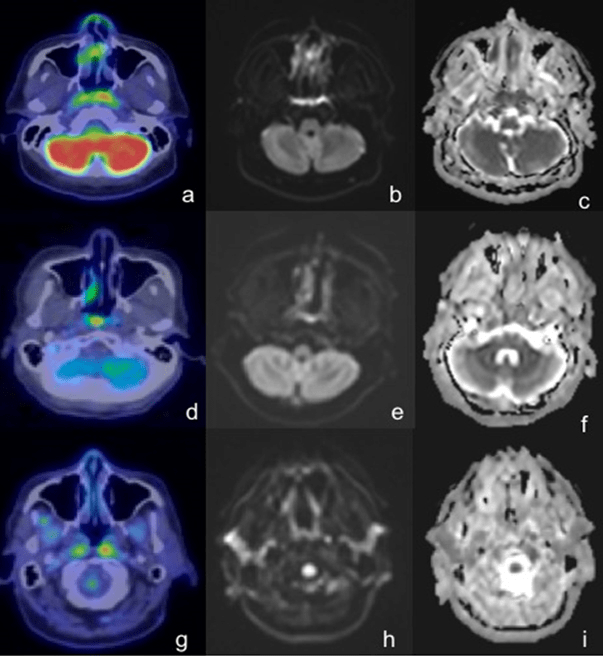 In 3 out of 9 Patients, PET/CT Demonstrated an Asymmetrical Increased Uptake