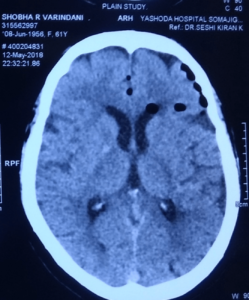 CT Image 1 Showing Air in the Cranium before Treatment