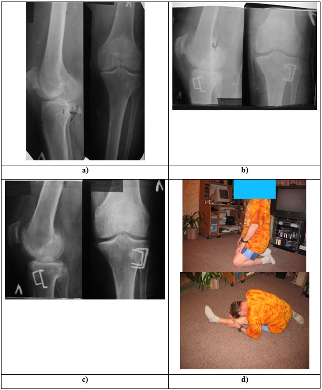 A 51-year-old male was treated using closed wedge high tibial osteotomy