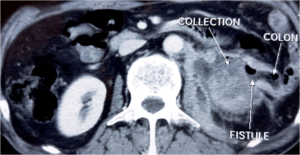 Axial Abdominal Enhanced CT Scan