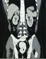 Laparoscopic Management of Adrenal and Extra-Adrenal