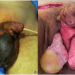 Figure 1. A. Pre-Operative Photo Showing External Genitalianecrosis and Hypogastric Erythema. B. Post-Operative Photo After Excision of the Necrotic Tissue and Discharge Incisions