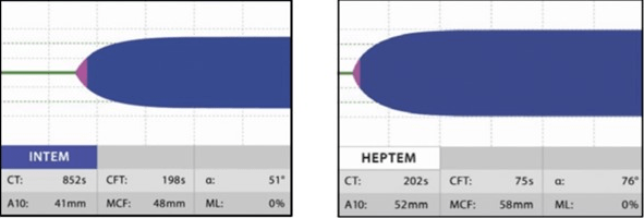 ROTEM Under the Effects of Heparin