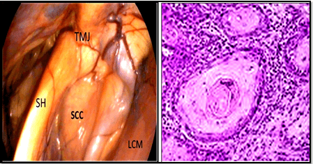 Showing the Location of The Squamous Cell Carcinoma