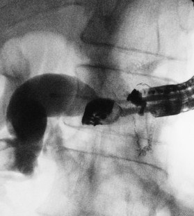 The echoendoscope is at the bottom of the gastric remnant
and the contrast medium flows in the afferent loop