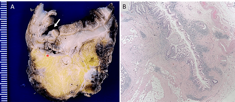 Figure 1: Panel A shows a gross picture of a cross section of the sigmoid colon with an arrow indicating a diverticulum and an asterisk indicating the site of perforation. Panel B shows 40x magnification of an H&E stained section showing a diverticulum with surrounding acute and chronic inflammatory infiltrate.