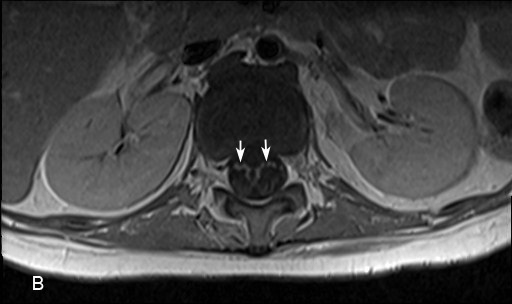 Contrast enhanced T1-weighted magnetic resonance sagittal