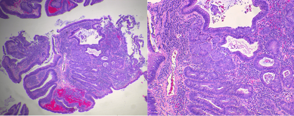 Multiple foci of squamous metaplasia in a tubulovillous adenoma