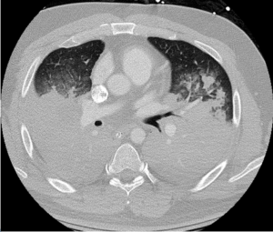 Hospital Day 1: Chest CT Imaging Demonstrating Widespread Consolidation of Lung Consistent with ARDS.