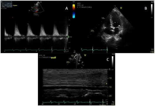 Images A-C Showing Echocardiographic Evidence of Pulmonary Hypertension