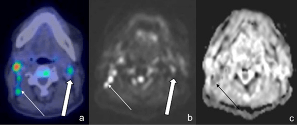 57-Year-Old Male with Right-Sided Cervical Nodal Involvement was Detected on both Modalities