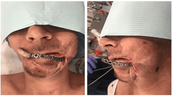 Mandibular Hardware Seen Protruding through an Eroded Defect in the Face
