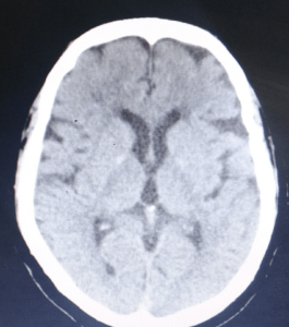 CT Image 2 Air Absorbed After Treatment