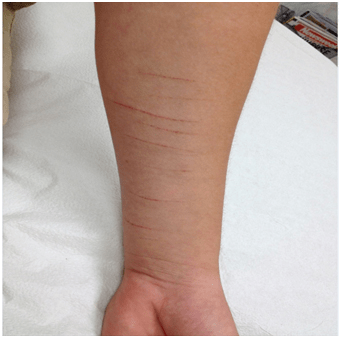 Scars from Cutting on the Ventral Forearms