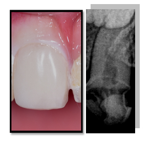 Acrylic Crown is Radiolucent and Glass Ionomer Cement is RadioOpaque
