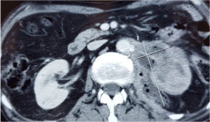 Axial Abdominal Enhanced CT Scan Showng Perinephric Abscess Extending to the Psoas Major Muscle Containing Gas Bubbles.