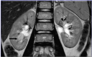 Uro-MRI (T2) Showed a Rounded Material With Defined Margin (15 mm) in the Inferior Calices.