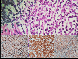 Testicular Metastasis of Merkel’s Cell Carcinoma