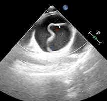 TTE with Visualisation of the Intimal Flap
