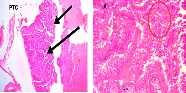 Histology Microscopically PTC Comprised of Papillae Lined by Neoplastic Follicular Epithelium