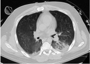 Computed Tomographic Imaging of the Chest Hospital Day 6, ECMO Day 6 Reveals Significant Resolution of Pulmonary Edema and Airspace Opacities.