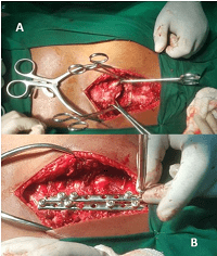 Surgical Treatment of Sternal Fracture: Case Report and Literature Review.