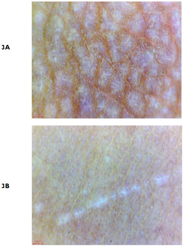 Dermoscopy of Skin Lesion Shows Shiny