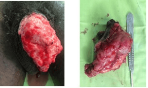 Squamous Cell Carcinoma Aspect