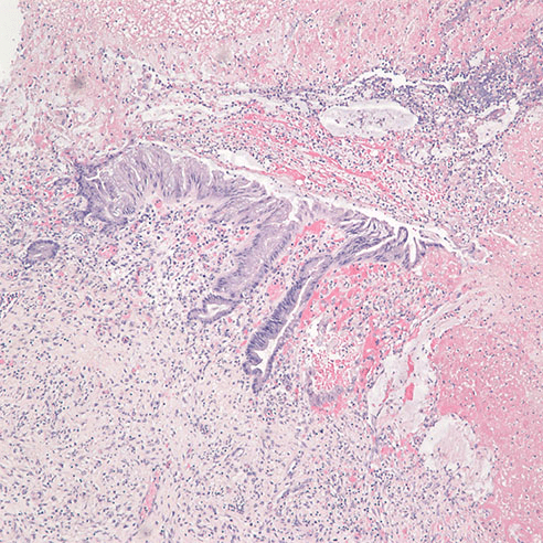 H&E at 40x, low grade mucinous neoplasm near the diverticulum